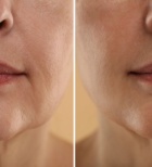 מיצוק העור - תמונת אווירה